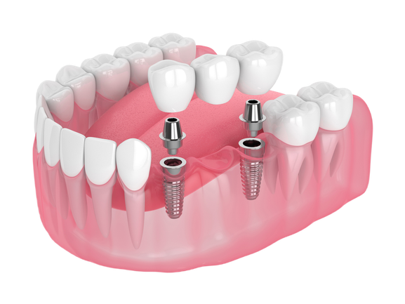 multiple-tooth-implant
