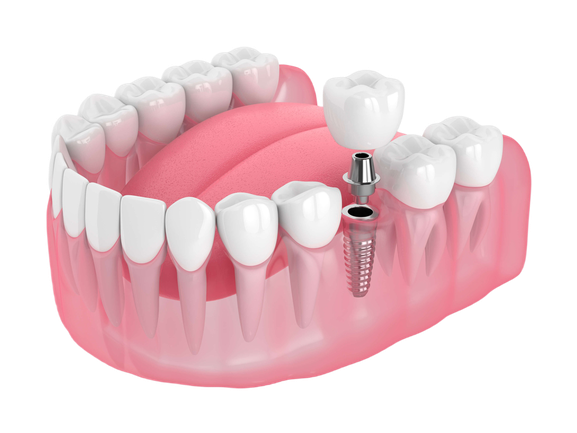 single-tooth-implant